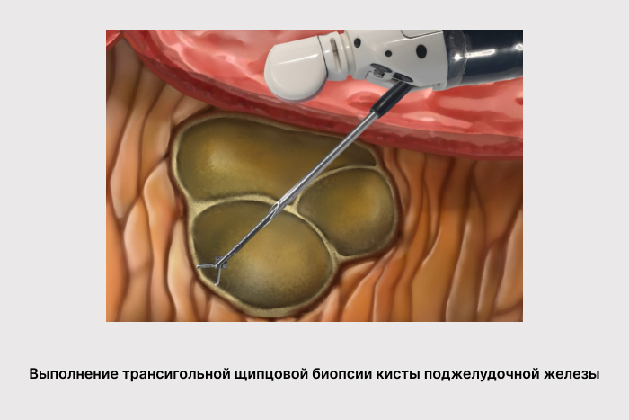 Новые возможности диагностики кистозных опухолей поджелудочной железы